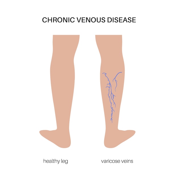 Vector tratamiento de venas varicosas