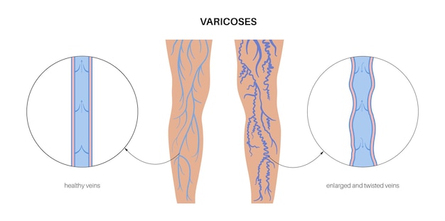 tratamiento de venas varicosas