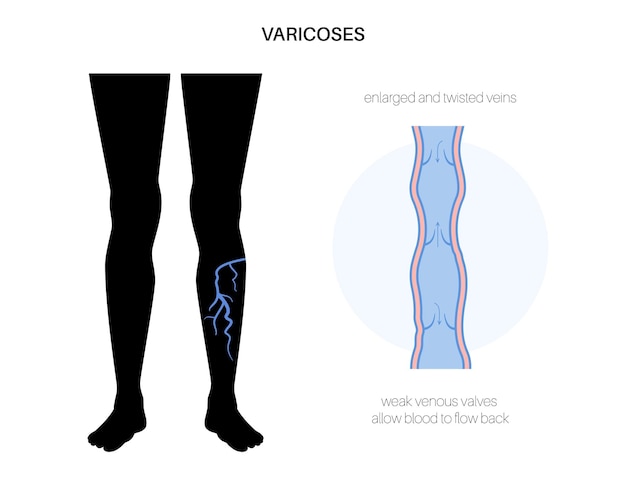 Tratamiento de venas varicosas