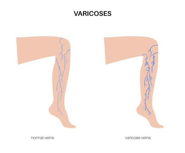 Vector tratamiento de venas varicosas