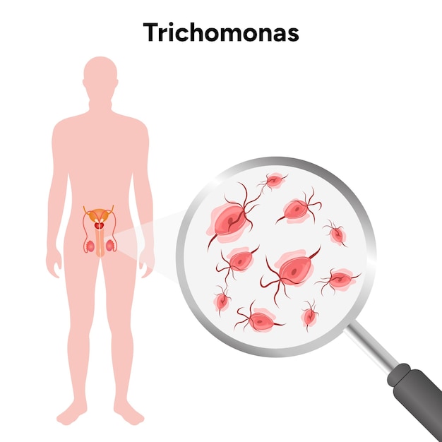 Trichomonas Vaginalis parásitos zoom hombres y mujeres enfermedad infecciosa