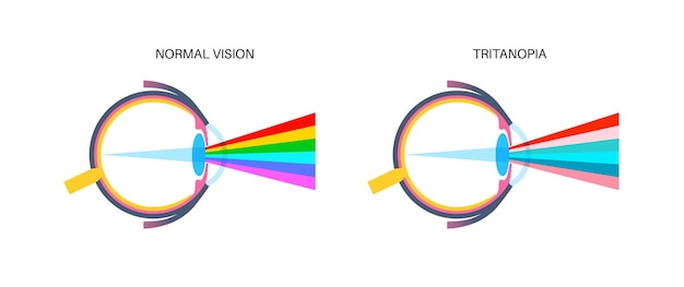 Vector tritanopía y tritanomalia