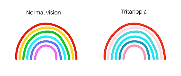 Vector tritanopía y tritanomalia