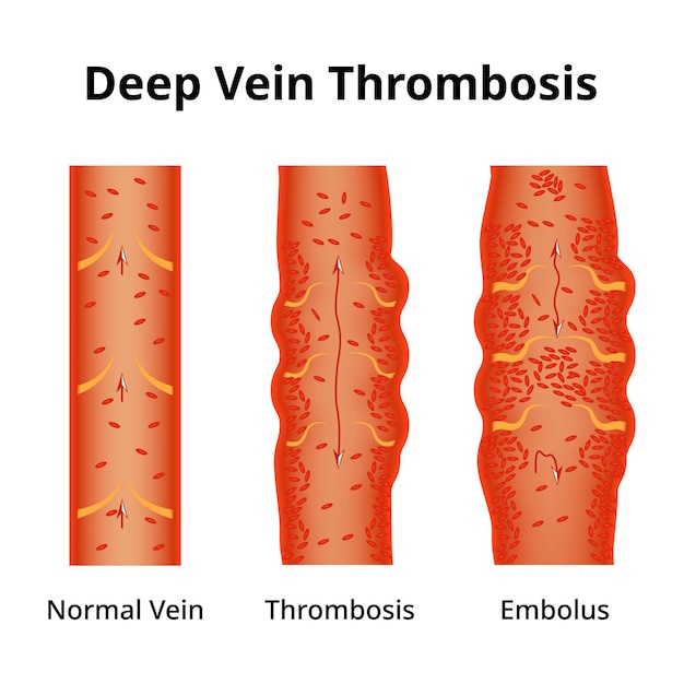 Trombosis venosa profunda Ilustración del vector del embolio de la trombosis venosa normal