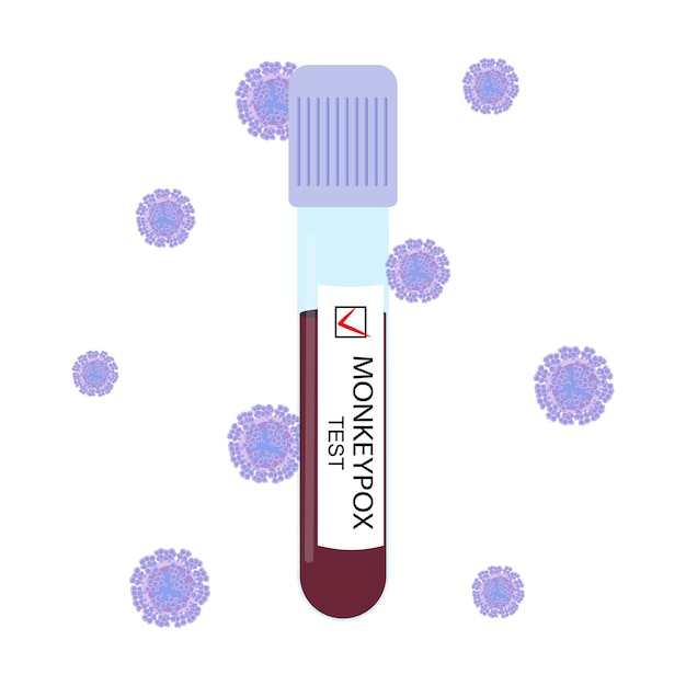 Un tubo de ensayo con la sangre de una persona con viruela del mono prueba positiva para el vector del virus