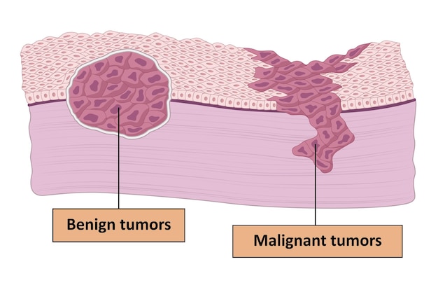 Vector el tumor