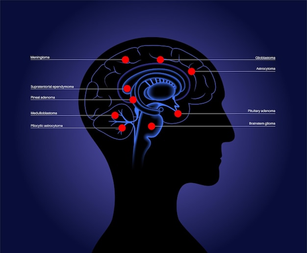 Tumores cerebrales primarios