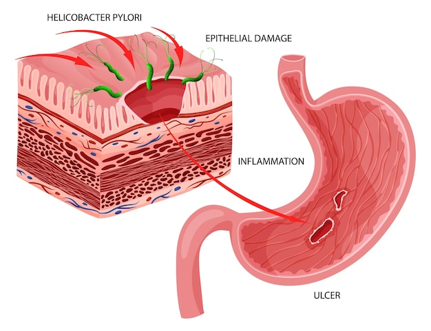 Úlcera estomacal causada por infección por helicobacter pylori