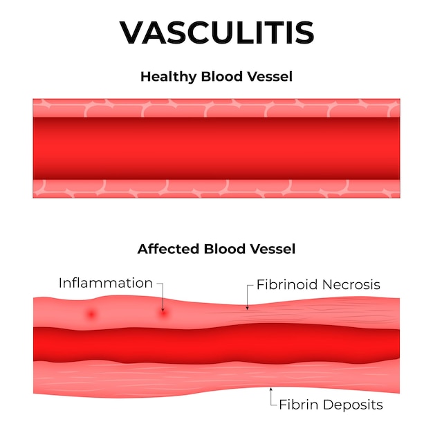 Vector vasculitis vaso sanguíneo sano afectado inflamación de los vasos sanguíneos fibrinoides necrosis de la fibrina