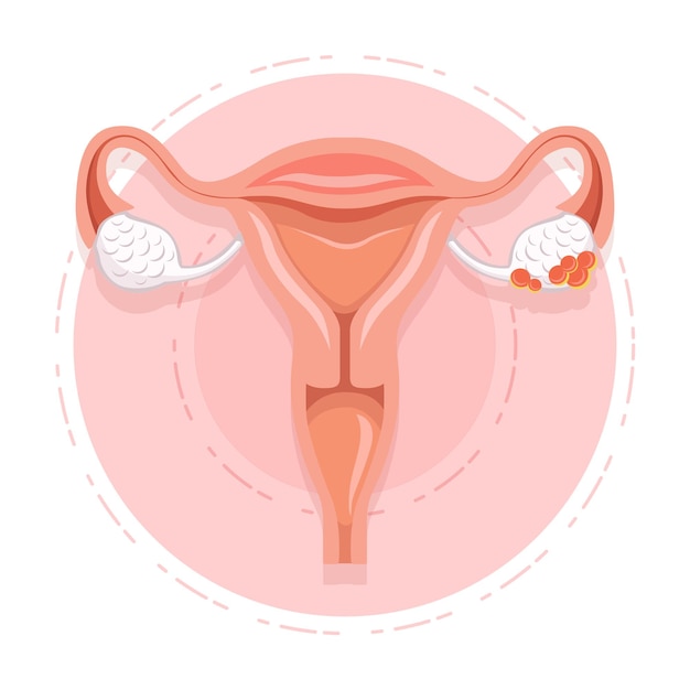 Vector de cáncer de ovario Salud de la mujer