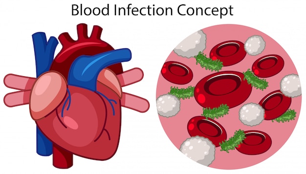 Un vector de concepto de infección de sangre