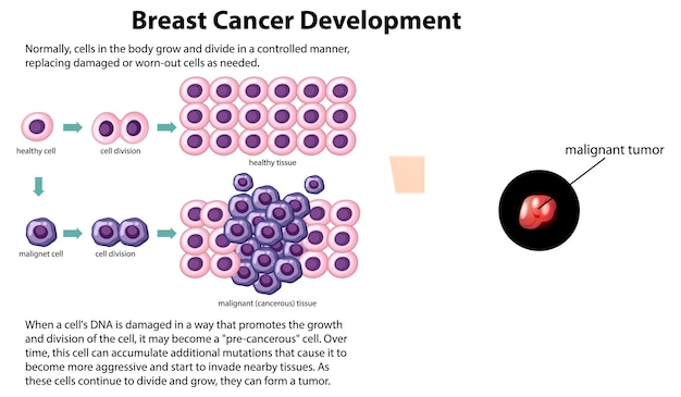 Vector de desarrollo del cáncer con información