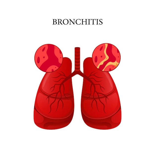 Vector de enfermedad de bronquitis, diseño de ilustración para médicos