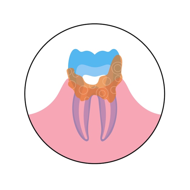 Vector ilustración aislada plana de cálculo dental, placa calcificada, sarro. Anatomia de los dientes