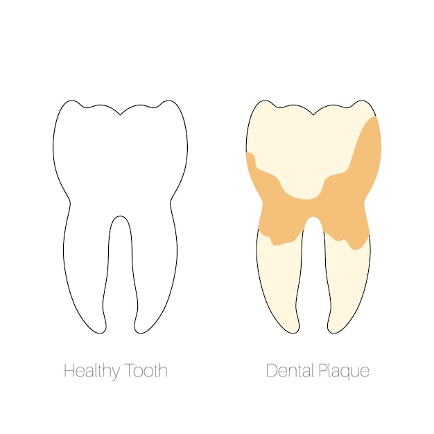 Vector ilustración aislada plana de cálculo dental, placa calcificada, sarro. anatomia de los dientes