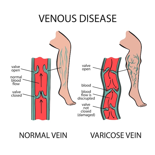 Venas varicosas enfermedad venosa de la educación en medicina humana