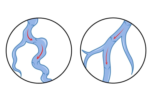 Vector venas varicosas vaso sanguíneo azul visible a través de la piel diagnóstico y tratamiento de enfermedades vasculares insuficiencia venosa médica