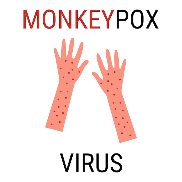 Virus de la viruela del mono enfermedad viral zoonótica que puede infectar primates humanos no humanos Viruela del mono Vector