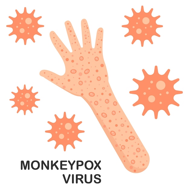 Virus de la viruela del mono en la mano y el brazo brote del virus de la viruela del mono como una infección contagiosa como ampollas y leisons ilustración vectorial