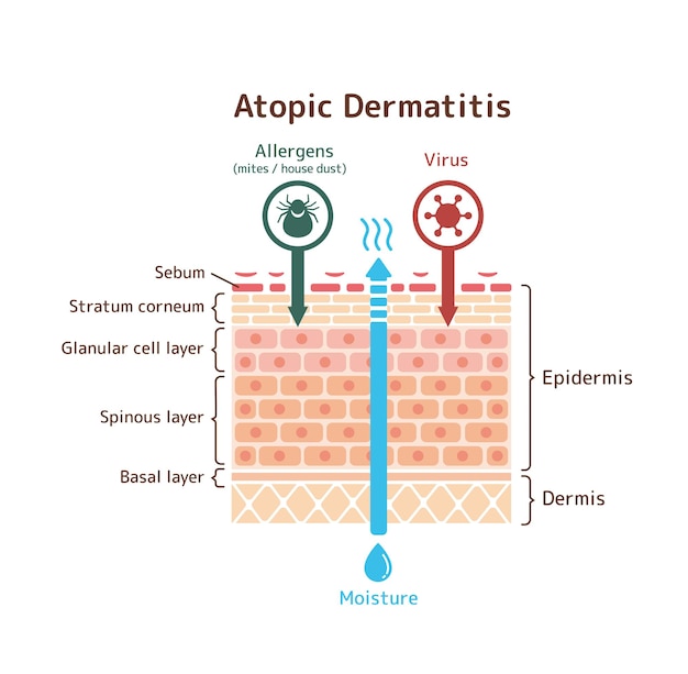 Vector visión en sección de la ilustración del vector de la dermatitis atópica