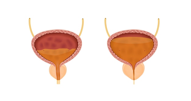 Vista frontal de la hiperplasia prostática benigna