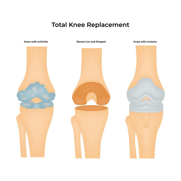 Vector visualización del proceso quirúrgico de reemplazo total de rodilla
