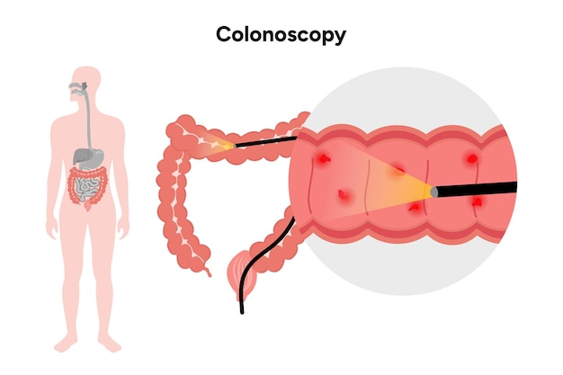 Zoom de la colonoscopia en el ser humano