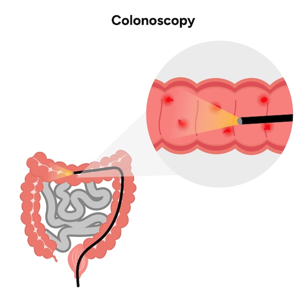 Zoom para la colonoscopia