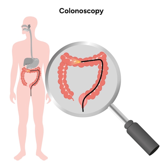 Zoom para la colonoscopia