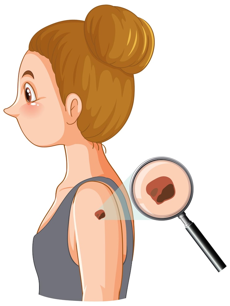 Vector Gratis abnormal skin cell growth leading to arm cancer