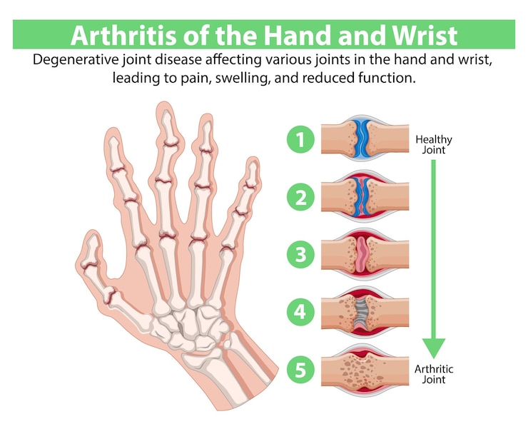 Vector Gratis arthritis of the hand and wrist