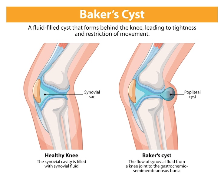 Vector Gratis bakers cyst in knee joint
