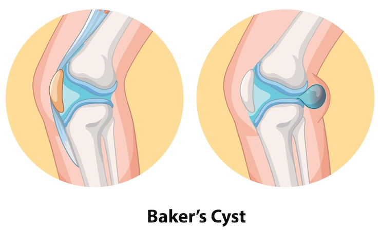 Vector Gratis bakers cyst in knee joint