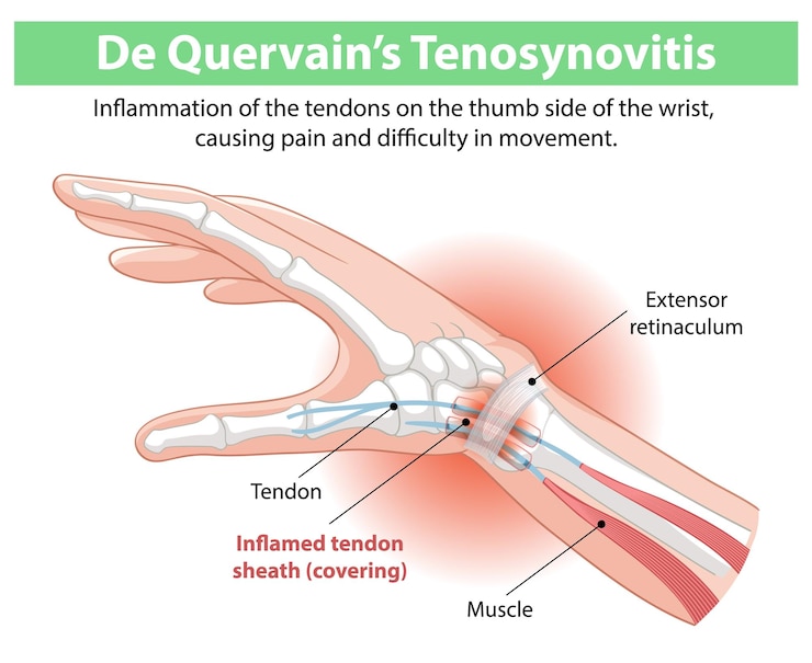 Vector Gratis de quervains tenosynovitis illustration