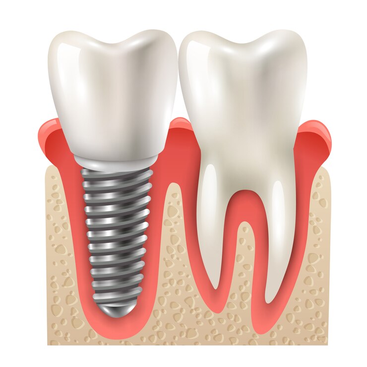 Vector Gratis dental implant tooth set closeup model 