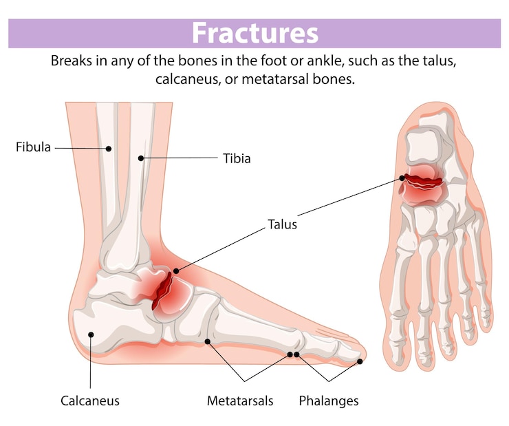 Vector Gratis diagram patah tulang kaki dan pergelangan kaki