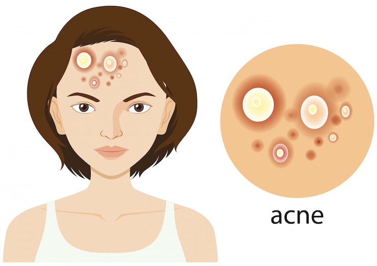 Vector Gratis diagram yang menunjukkan wanita dengan masalah jerawat