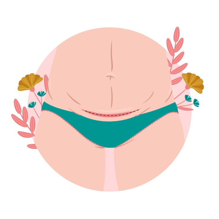 Vector Gratis flat design cesarean section incision