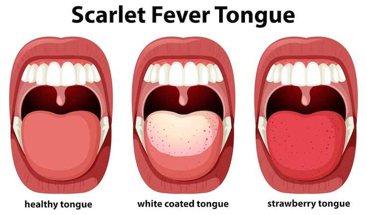 Vector Gratis gejala lidah demam scarlet