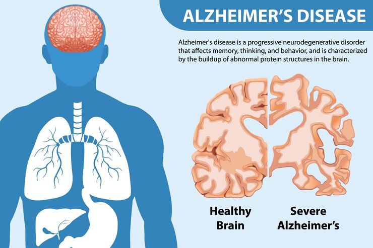 Vector Gratis informative poster of alzheimers disease