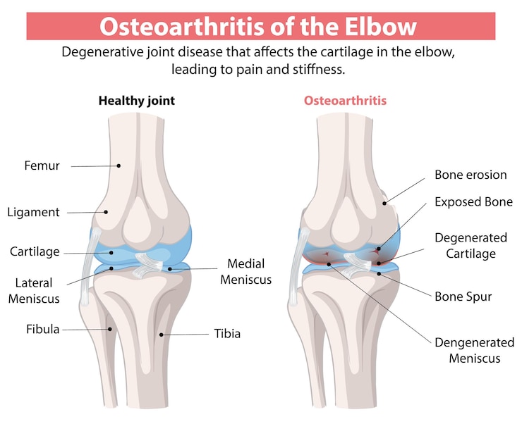 Vector Gratis osteoarthritis of the elbow