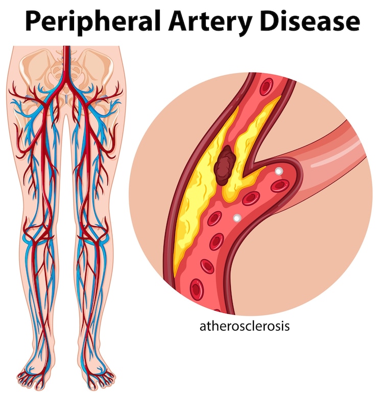 Vector Gratis penyakit arteri perifer medis