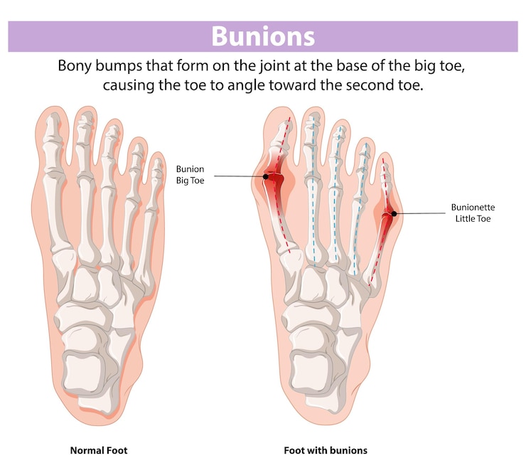 Vector Gratis penyebab dan akibat bunions