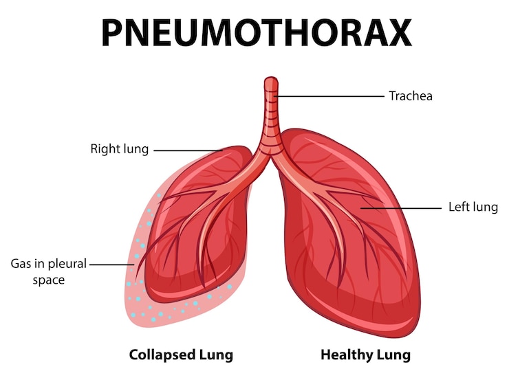 Vector Gratis pneumothorax diagram with collapsed lung and healthy lung