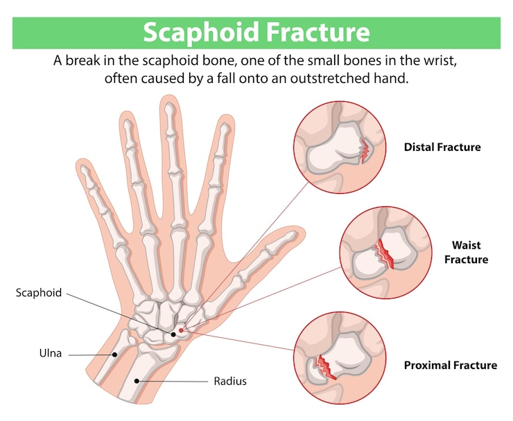 Vector Gratis scaphoid fracture diagram