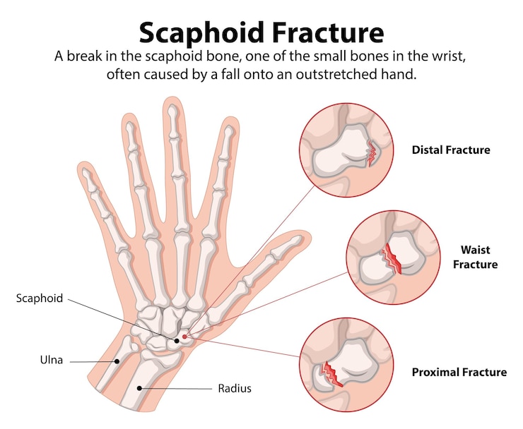 Vector Gratis scaphoid fracture illustration
