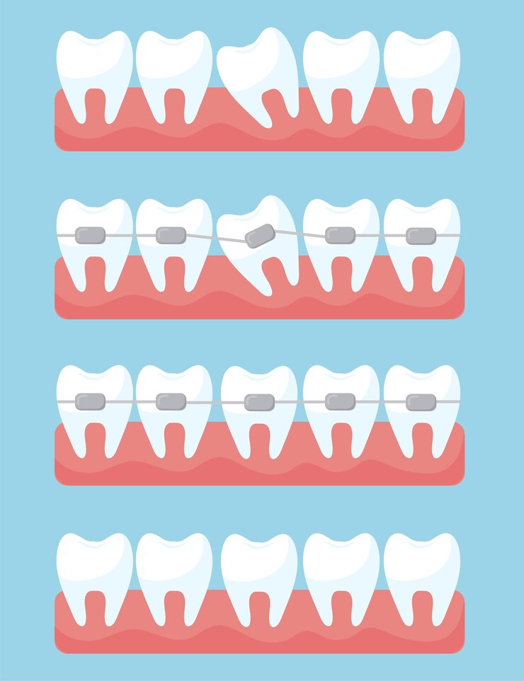 Vector Gratis tooth with orthodontic braces set