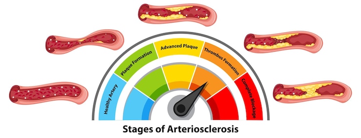 Vector Gratis understanding arteriosclerosis stages and progression