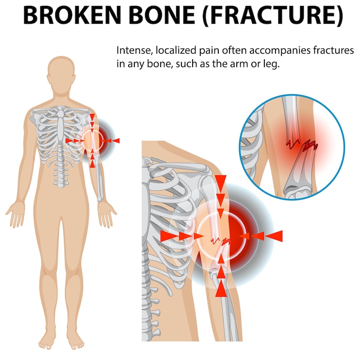 Vector Gratis understanding broken bone fractures