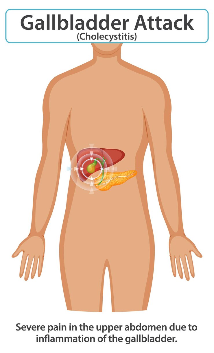 Vector Gratis understanding gallbladder attack symptoms